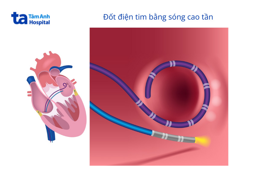Hình ảnh minh họa thủ thuật đốt điện tim ablation