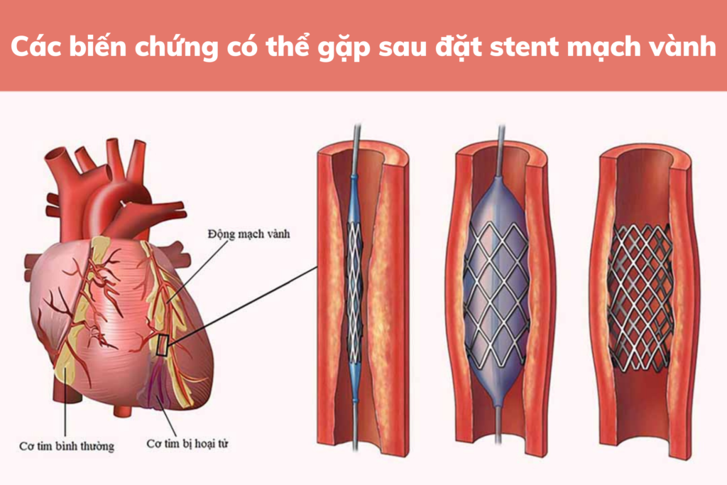 Nghien cưu các Biến chứng trong can thiệp đăt stent mạch vành thì đầu ở bệnh nhân nhồi máu cơ tim cấp bệnh viện tỉnh gia lai